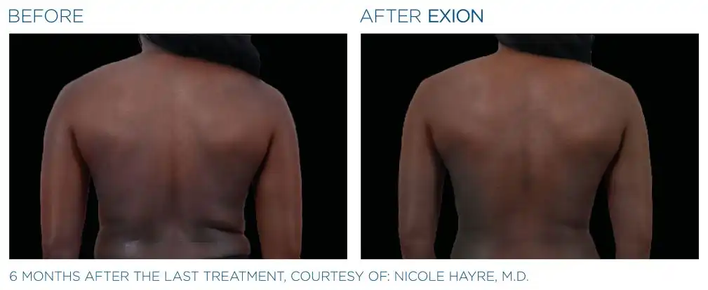 Exion 18