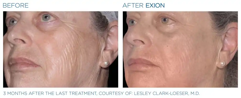 Exion 17