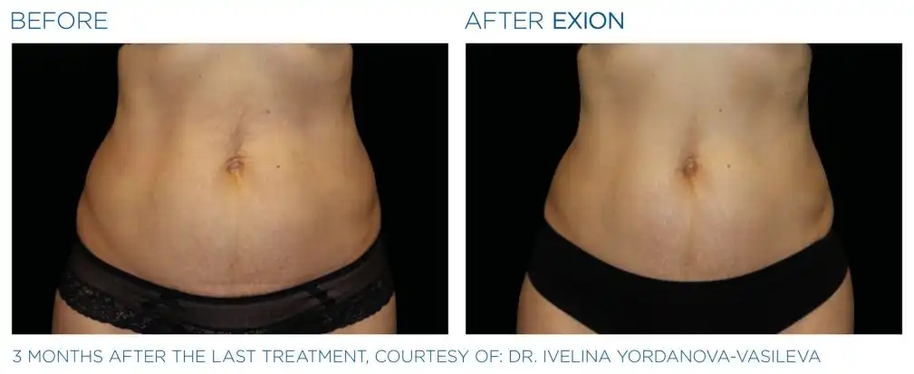 Exion 19