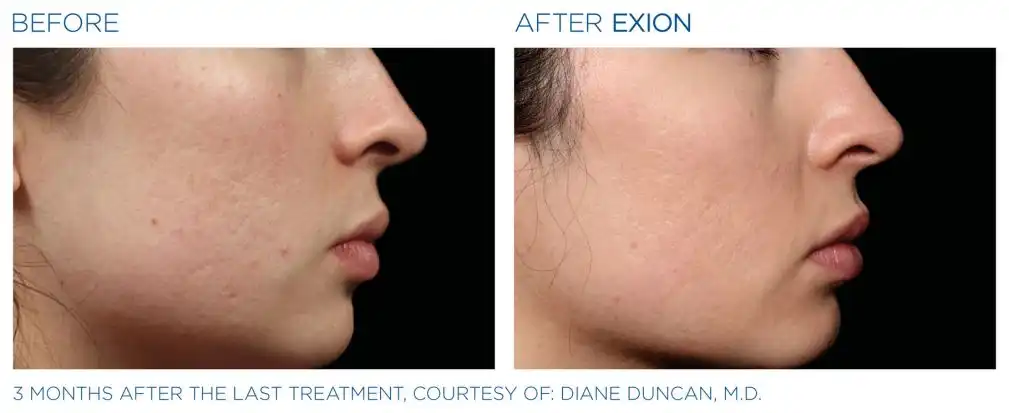 Exion 20