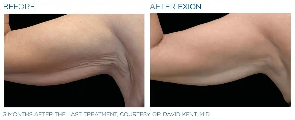 Exion 21