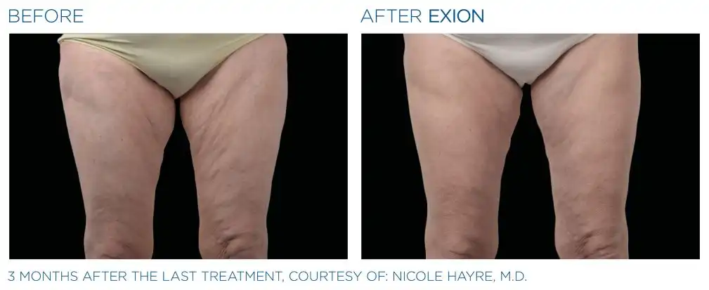 Exion 22