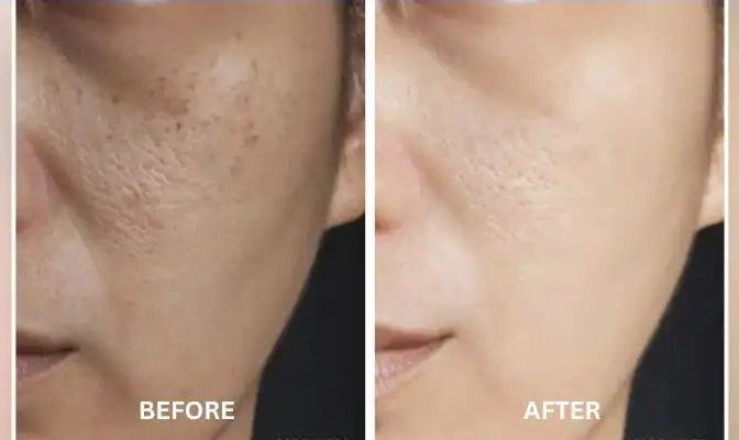 Chemical Peels 60