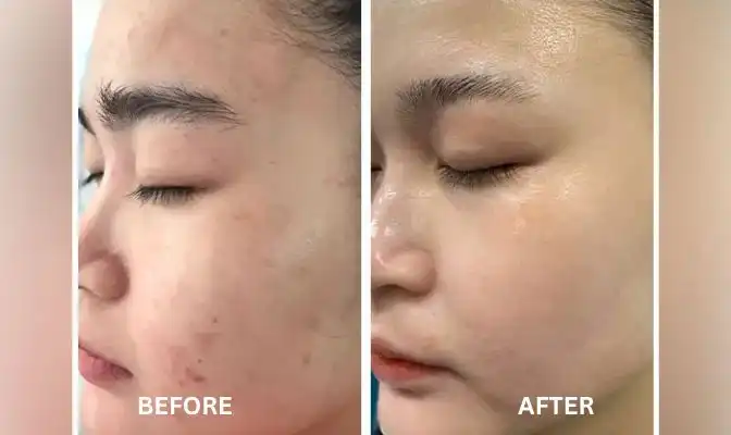 Chemical Peels 61