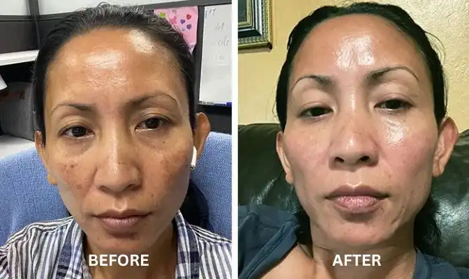 Chemical Peels 62