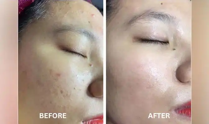 Chemical Peels 63